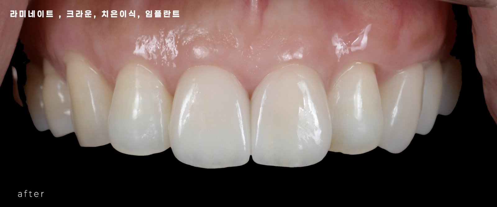 청주 라미네이트치료, 최소삭제라미네이트, 무삭제라미네이트