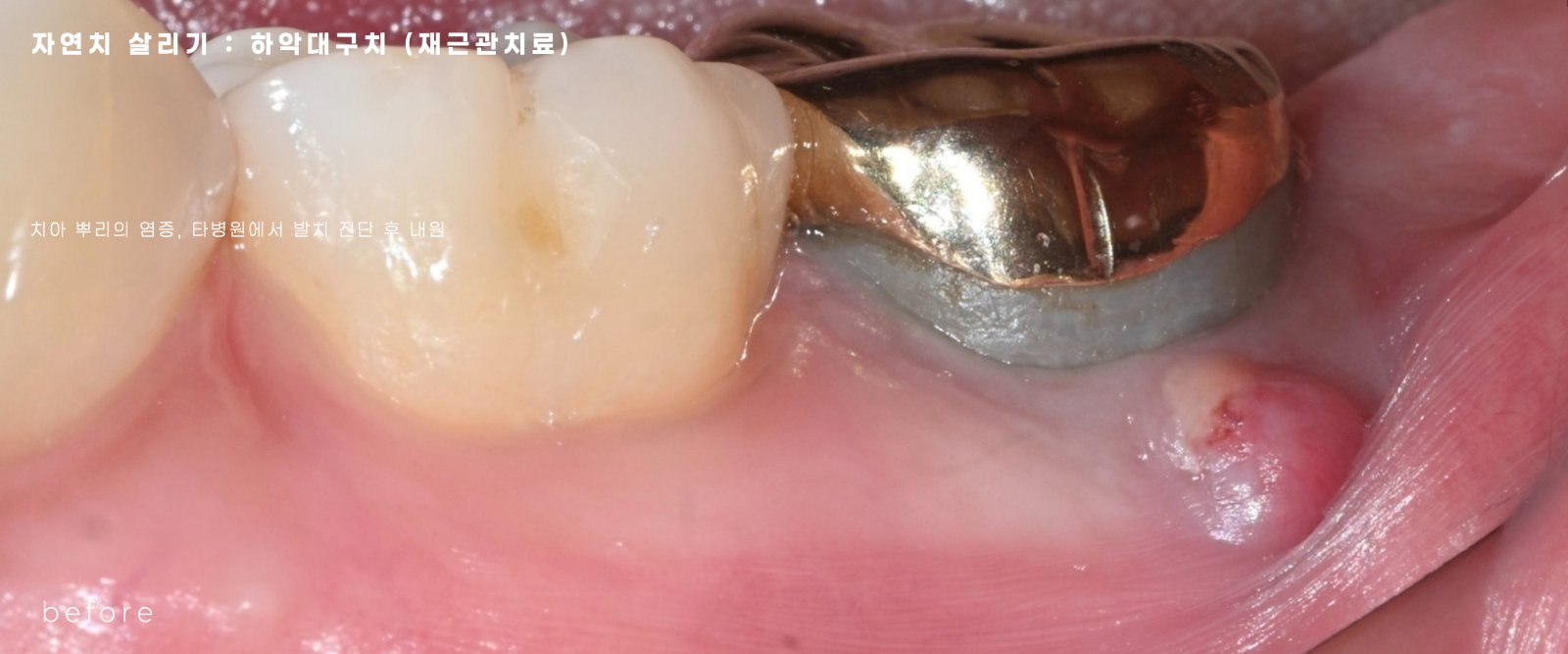 치아를 빼지 않고, 살리는 청주 치과 추천