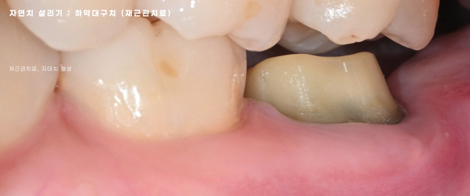 미세현미경 신경치료, 재신경치료, 청주치과